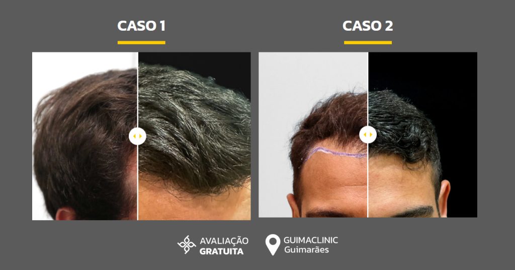 casos de transplante capilar antes e depois CapilarPro
