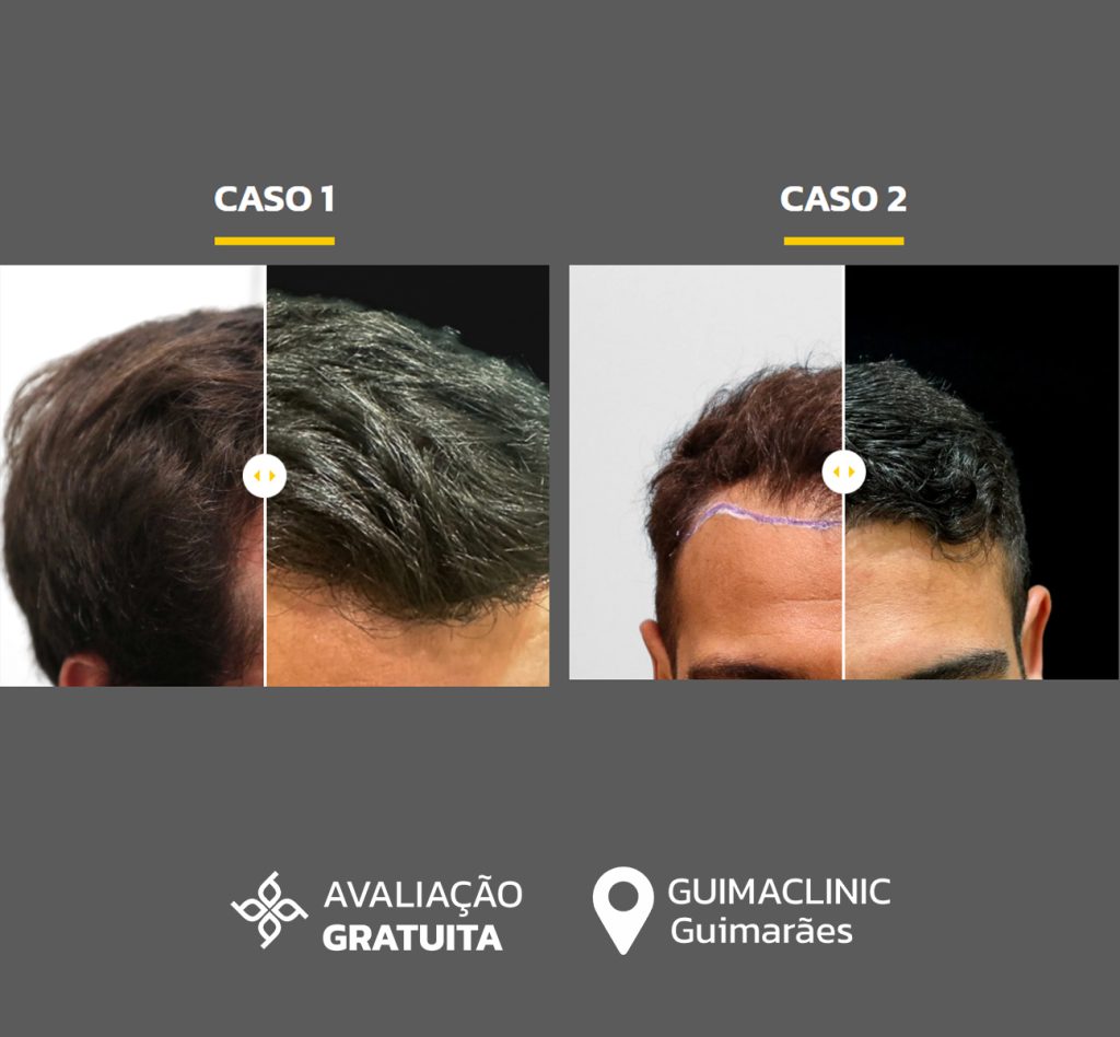 casos de transplante capilar antes e depois CapilarPro